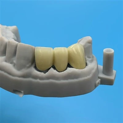 Non-Precious PFM Bridge